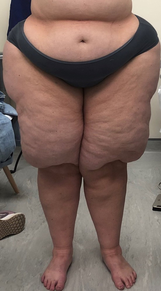 صورة سريرية لليبيديما في الساقين